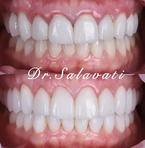 Before and after smile transformation showing dental veneers results in Beverly Hills.
