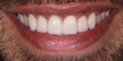 After veneer repair