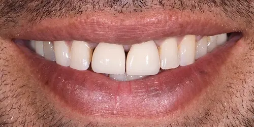 Before veneer repair