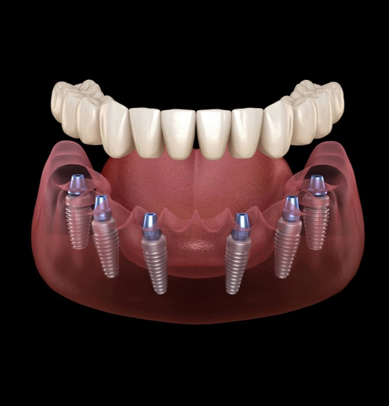 All-on-X dental implant restoration with a full arch of prosthetic teeth