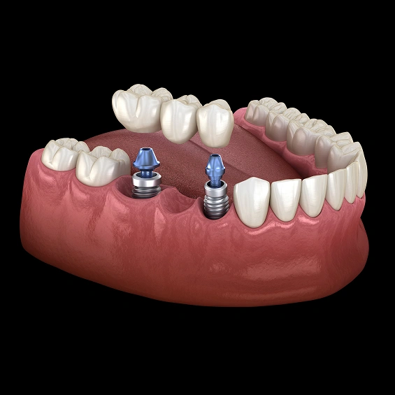 Custom dental bridge replacing missing teeth with a natural-looking restoration