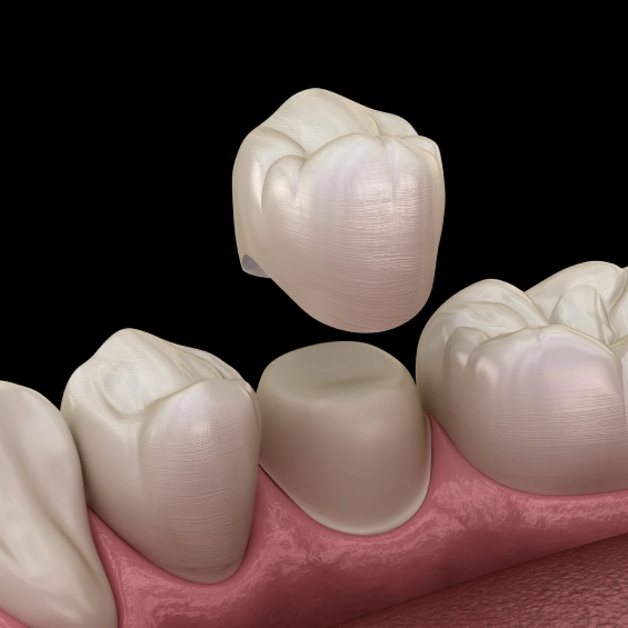 Ceramic dental crowns designed to restore damaged teeth