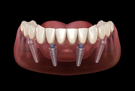 All-on-4 dental implant restoration with a full arch prosthesis