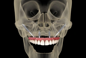 Ceramic zirconia dental implants for metal-free tooth replacement