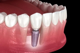 Titanium dental implant restoration replacing missing teeth