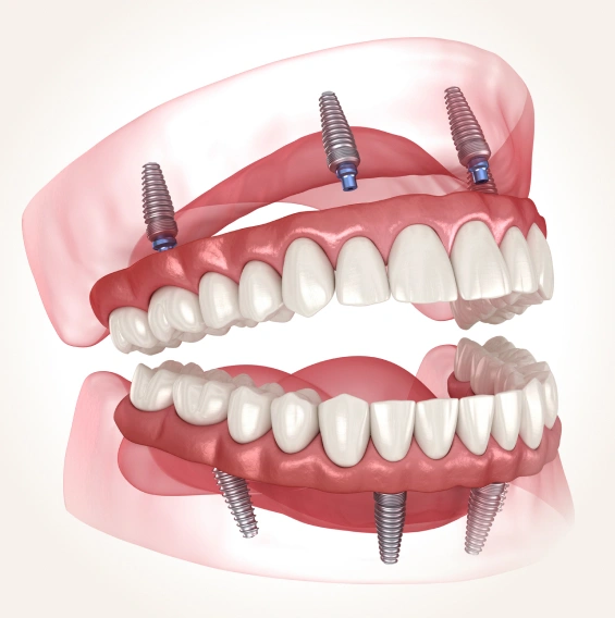 Illustration of a full-mouth reconstruction using dental implants