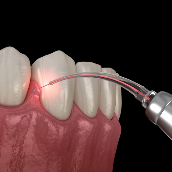 Laser dentistry procedure for precise, minimally invasive dental treatment