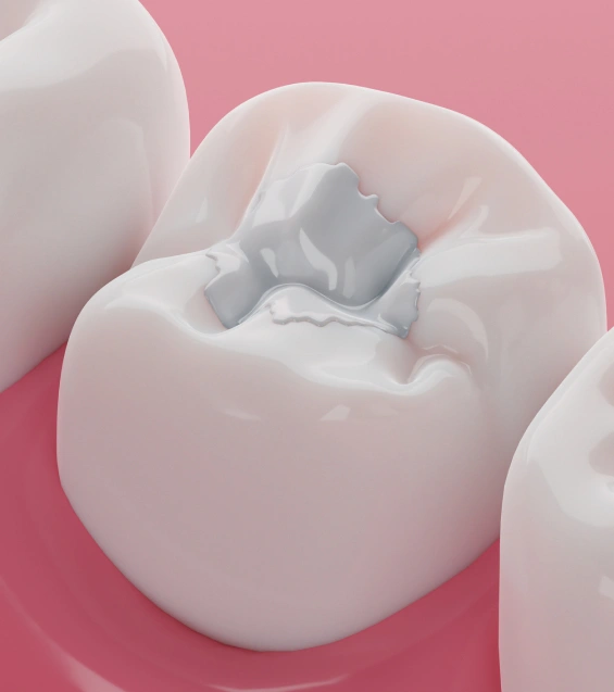 Tooth illustration showing safe amalgam filling removal and restoration