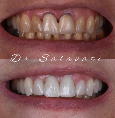 The two front crowns to zirconia crowns to mask the darkness. Additionally, minimally invasive veneers were applied to the remaining upper teeth to improve the aesthetics