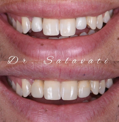 Removed 20-year-old crowns from implants #7 and 10, preserving abutments and adjusting margins for more esthetic look, crafted two crowns for a seamless blend