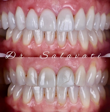 10 units of upper dental porcelain veneers and slight gum lift using laser