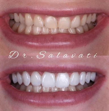 Smile transformation with 10 units of prepless veneers
