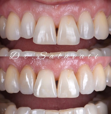 2 prepless veneers offer a non-invasive, painless solution