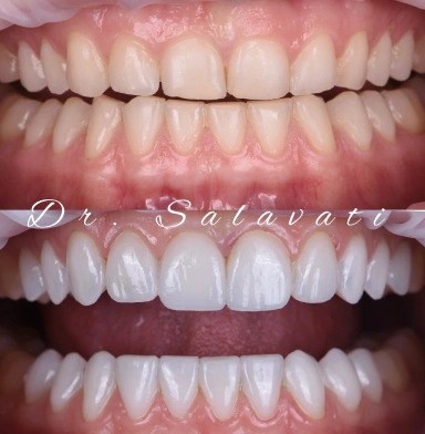 20 units no-prep Ceramic veneers, and the results are still jaw-dropping