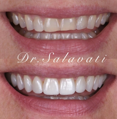 Cosmetic smile makeover before and after with whiter, even teeth