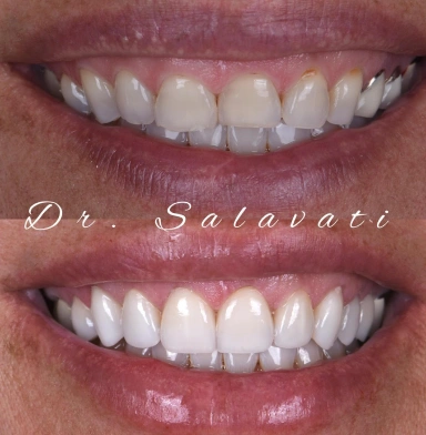 gum lift, 8 units of veneers and 2 units of crowns were inserted, seamlessly blending with the natural teeth for a flawless finish
