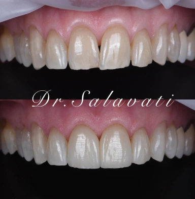 two central veneers with minimum preparation, blending seamlessly with their natural teeth