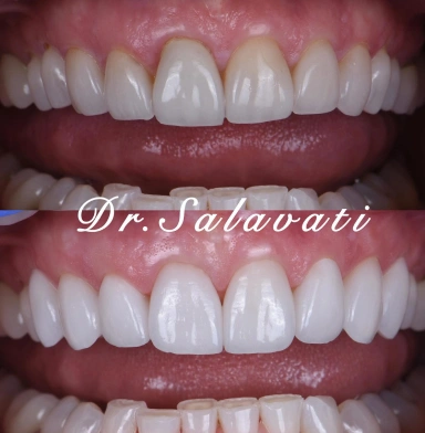 upper 6 veneers and added 2 no-prep veneers to the premolars for a seamless, blended smile