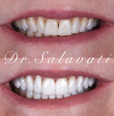 Transforming smiles with no prep veneers