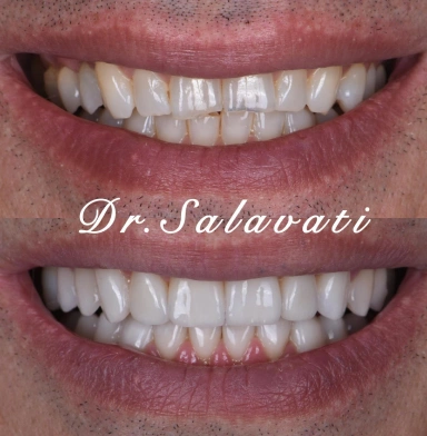 Before and after dental veneers improving tooth shape, color, and alignment