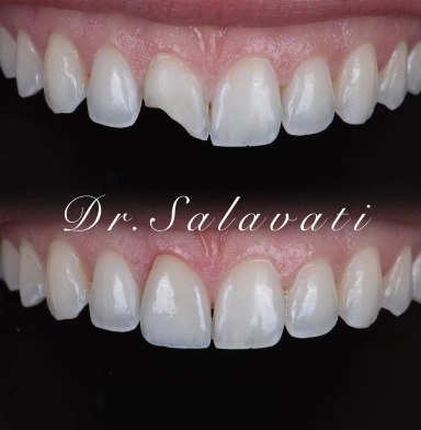 Single central veneer — the ultimate test of precision