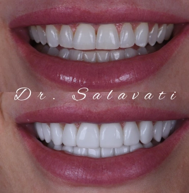 20 units of no-prep veneers and 4 units of no-prep Vonlays