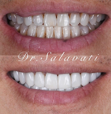 full-mouth no-prep veneers beautifully done after Invisalign — preserving natural enamel while delivering a stunning result