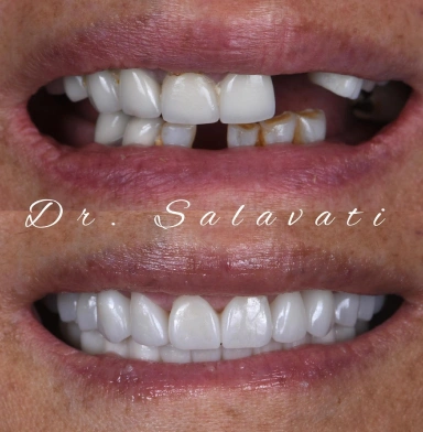 Treatment included the extraction of lower teeth with immediate implant placement, two sets of temporary restorations, and a final restoration with Zirconia all-on-4 full arch