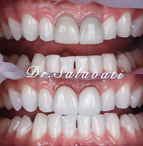 Before-and-after of a smile with a gap between front teeth closed using cosmetic dental treatment, creating a uniform appearance.