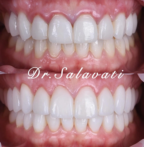 Before-and-after of a smile showing uneven front teeth corrected with veneers, resulting in a straight and bright smile.