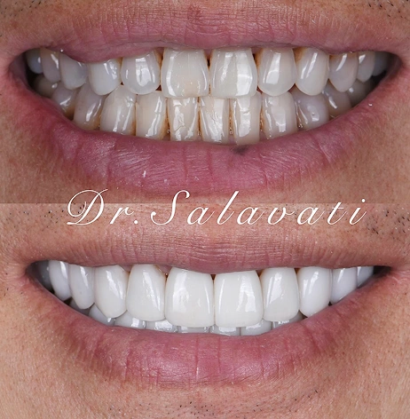 Before-and-after of a smile with yellowed and worn teeth transformed into a bright, white, and even smile through professional dental care.